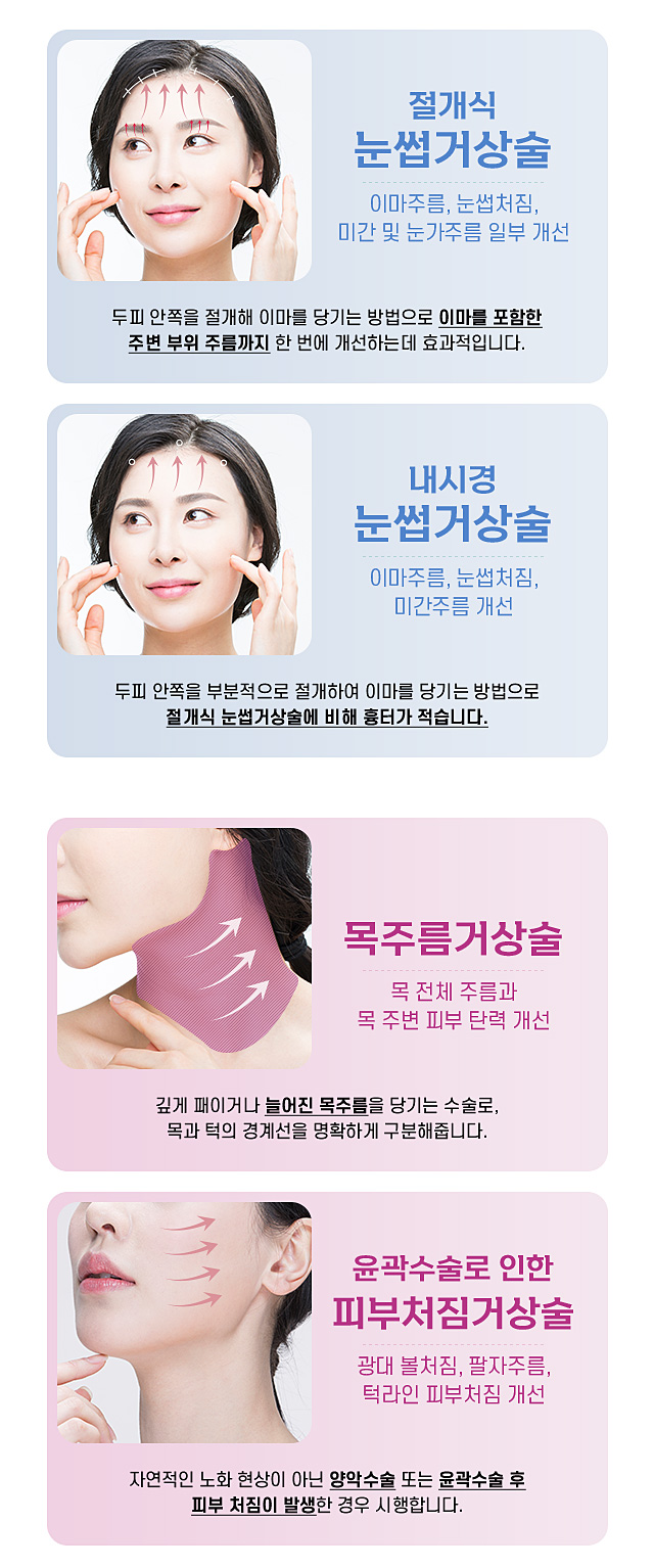 스트롱방식종류