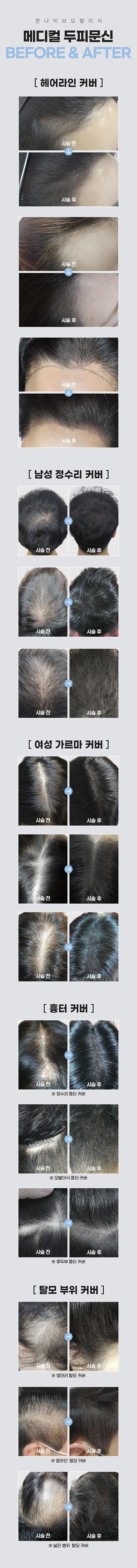 한나이브모발이식,전후사진