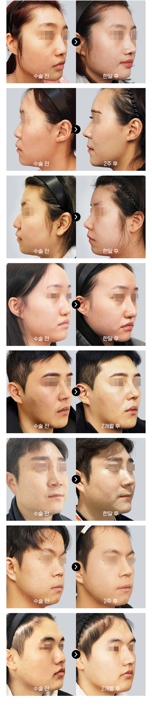 코성형전후사진